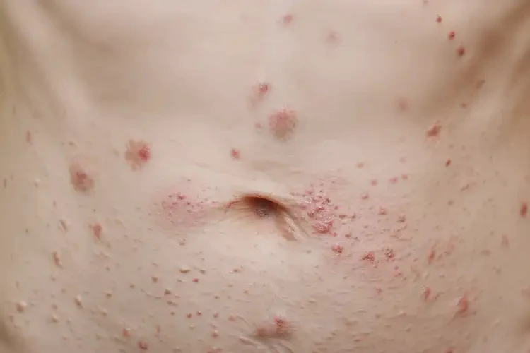 青少年肚子容易長濕疹可不可以徹底自愈(圖4)