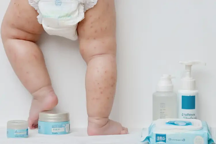 幼兒屁股上經(jīng)常起濕疹可以徹底自愈嗎(圖1)