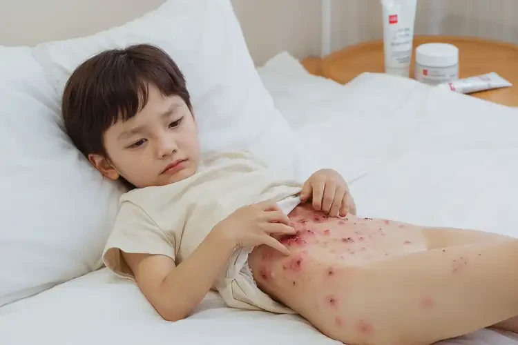 孩子肚子上出濕疹不管它會(huì)自己自愈嗎(圖4)