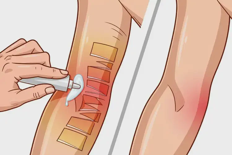 男生手臂上容易長濕疹能夠徹底治愈嗎(圖2)