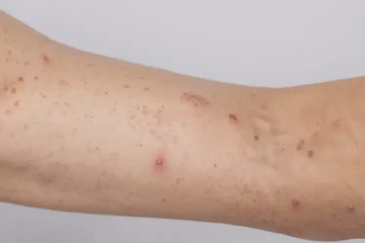 青少年手臂上出現(xiàn)濕疹不管它會自己痊愈嗎(圖4)