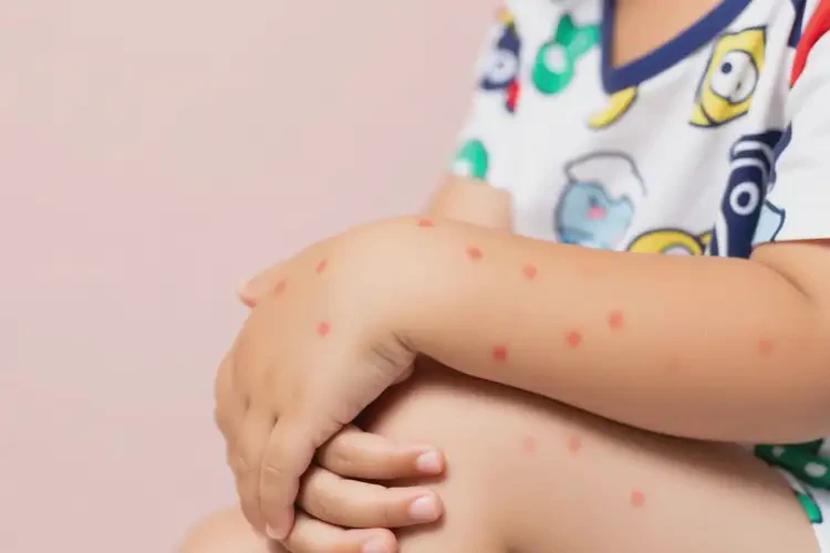 小孩手臂經(jīng)常長濕疹能徹底自愈嗎(圖2)