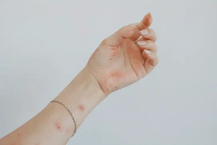 女性手上長濕疹不管它會自己好嗎(圖4)