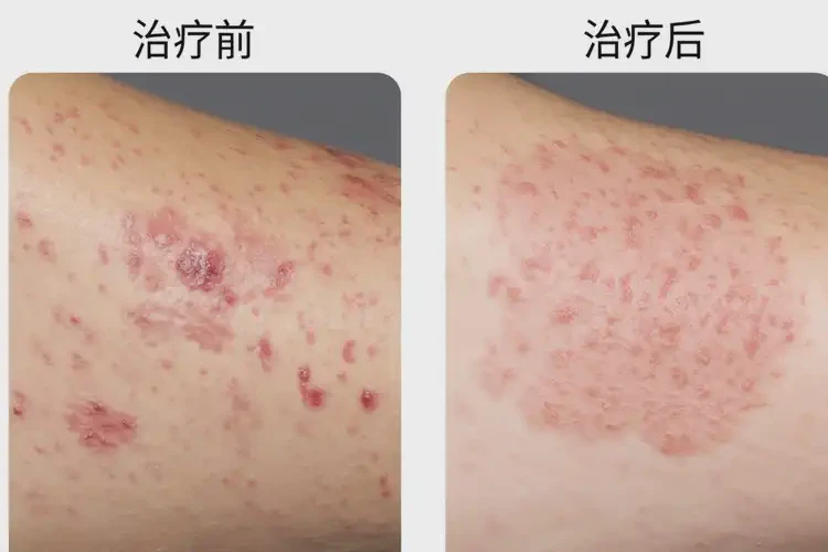 男生四肢容易起濕疹可以徹底自愈嗎(圖3)