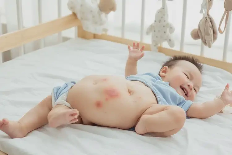 小兒肚子長(zhǎng)濕疹可不可以徹底自愈(圖4)