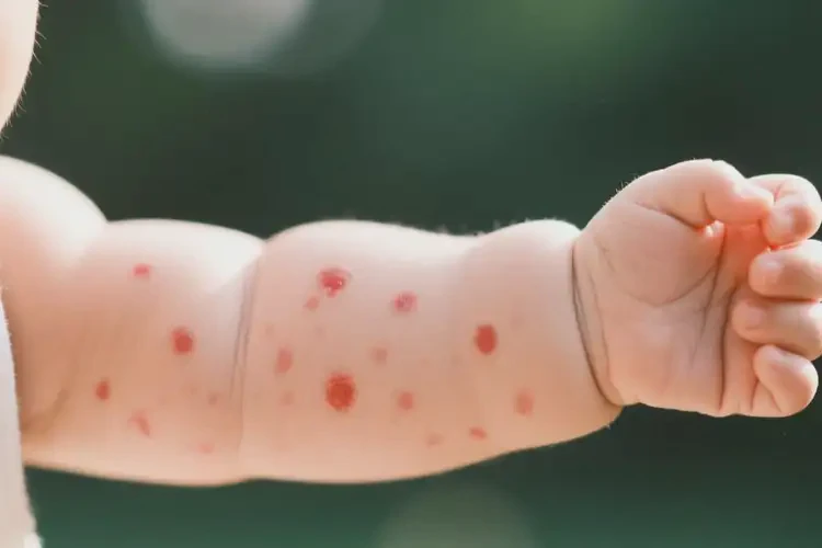 嬰幼兒全身出濕疹不管它會(huì)自己痊愈嗎(圖3)