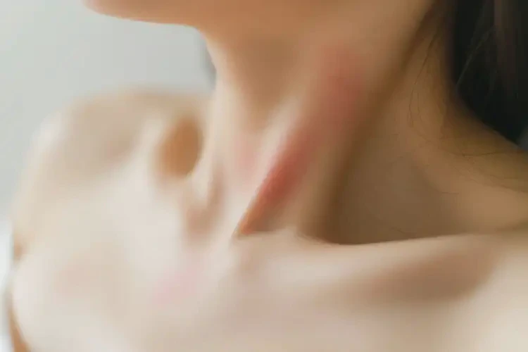 產(chǎn)婦脖子上起濕疹不管它會自己痊愈嗎(圖4)