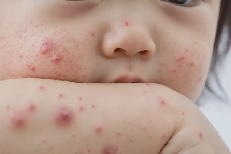 幼兒全身長(zhǎng)濕疹能徹底自愈嗎(圖4)