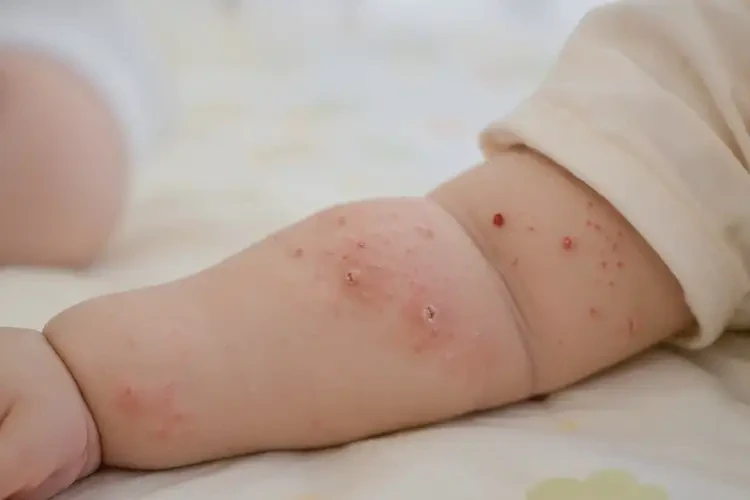 婴儿手臂容易起湿疹不管它会自己好吗(图4)