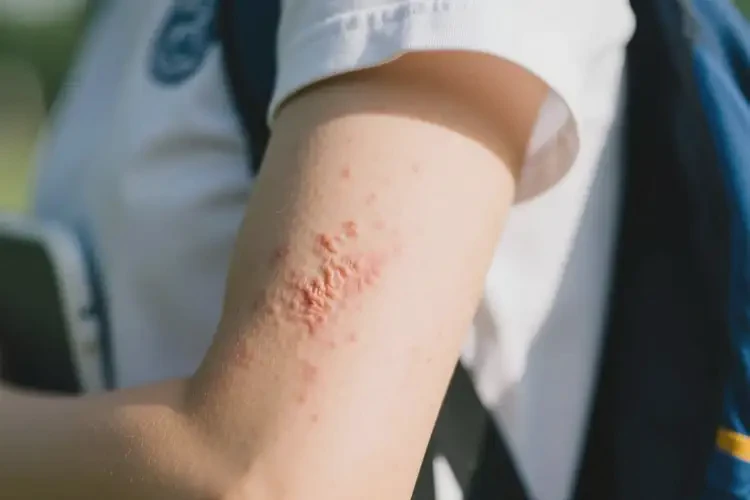 大學生手臂上出現(xiàn)濕疹能徹底自愈嗎(圖3)