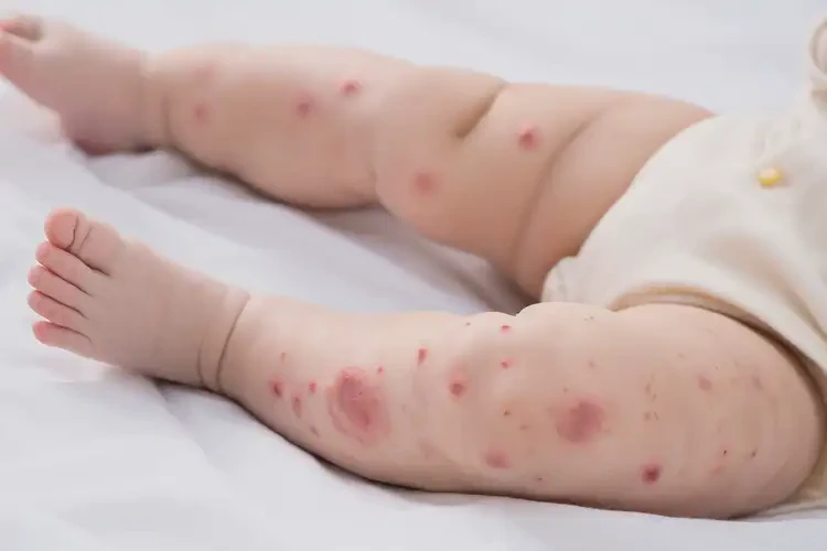 嬰幼兒大腿上偶爾長濕疹不管它會自己好嗎(圖4)