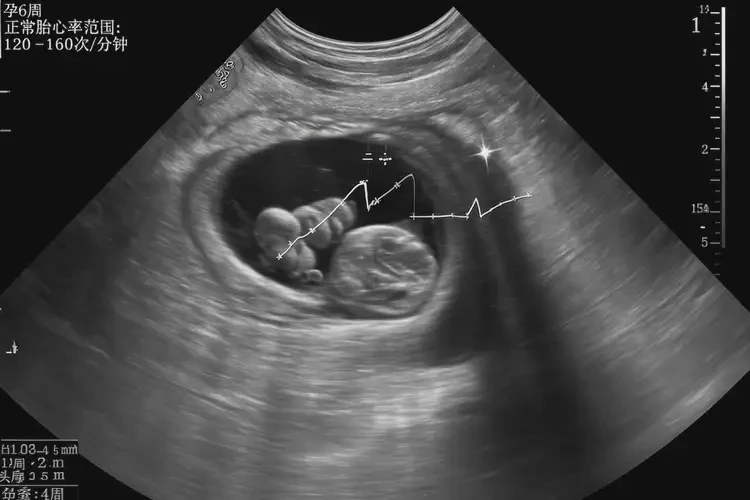 孕6周胎心率77寶寶還能要嗎(圖4)