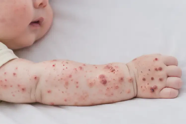 嬰兒四肢偶爾長濕疹可以徹底自愈嗎(圖3)
