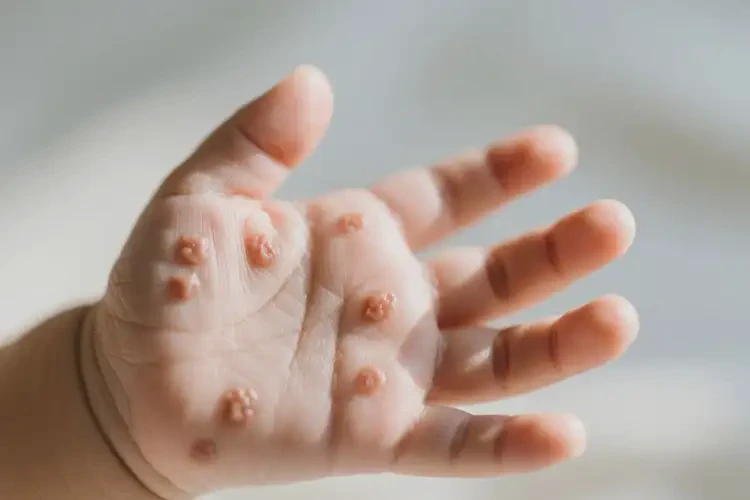 新生兒手上偶爾起濕疹能徹底自愈嗎(圖2)