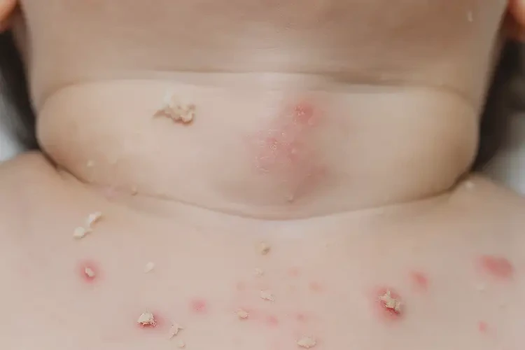 幼兒脖子容易長濕疹能夠徹底治愈嗎(圖4)