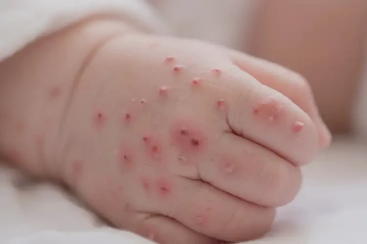 新生兒手上出現(xiàn)濕疹能夠徹底治愈嗎(圖4)
