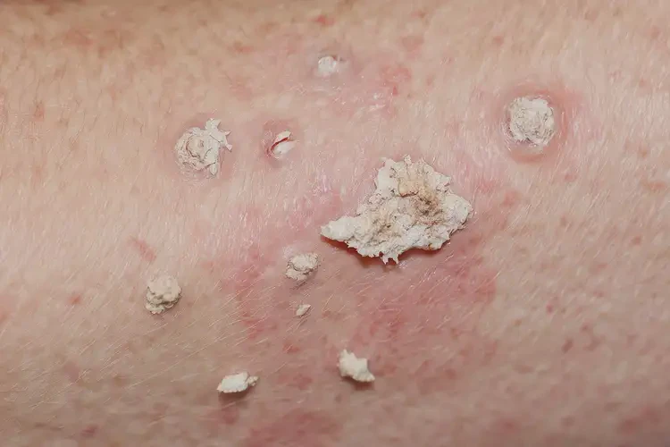 小學(xué)生手臂上容易起濕疹不管它會自己好嗎(圖3)