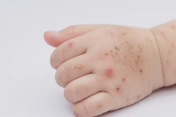 孩子手上偶尔长湿疹不管它会自己痊愈吗(图4)