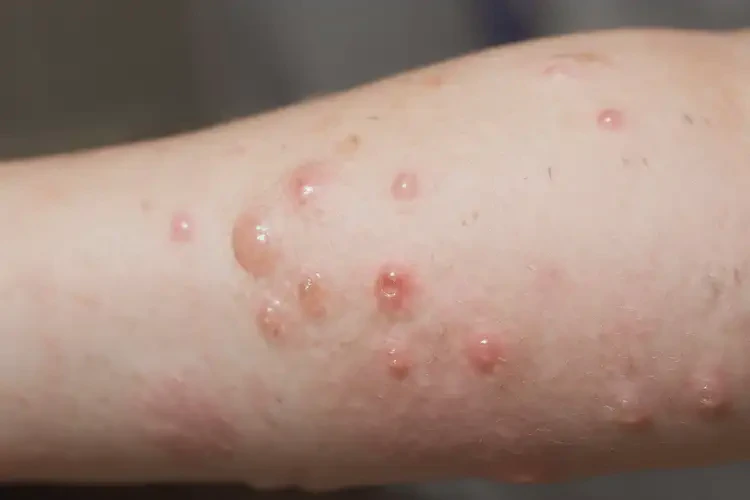 小学生手臂起湿疹能不能彻底自愈(图4)