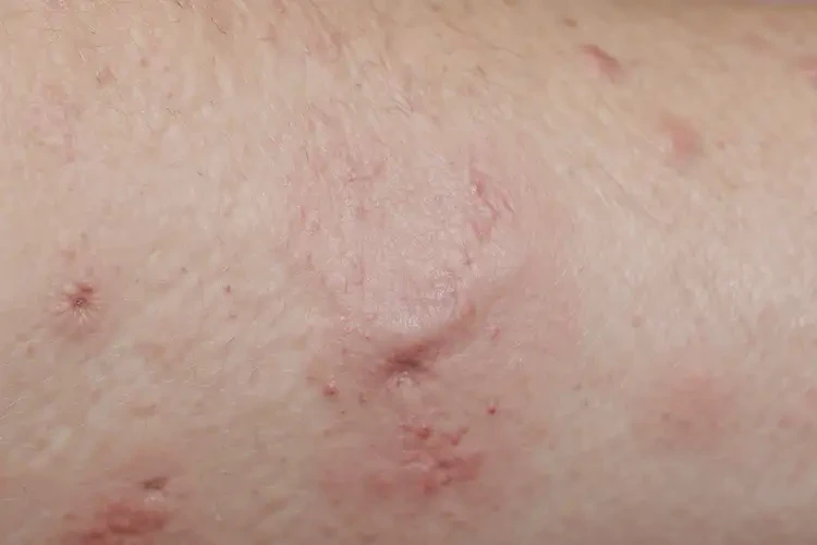 女生大腿上出現(xiàn)濕疹可以徹底自愈嗎(圖4)