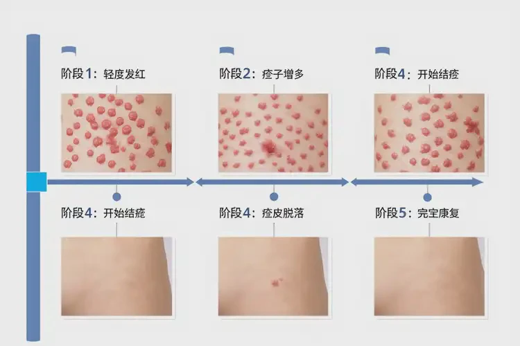 男生屁股偶爾長濕疹可以徹底自愈嗎(圖3)