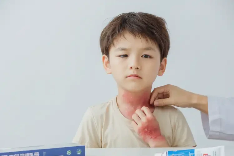 小兒脖子出濕疹不管它會(huì)自己好嗎(圖4)