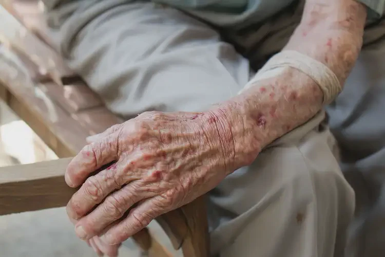 老人四肢偶爾長濕疹可不可以徹底自愈(圖4)