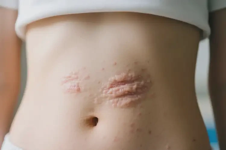 女生肚子上容易長濕疹能靠自己自愈嗎(圖3)