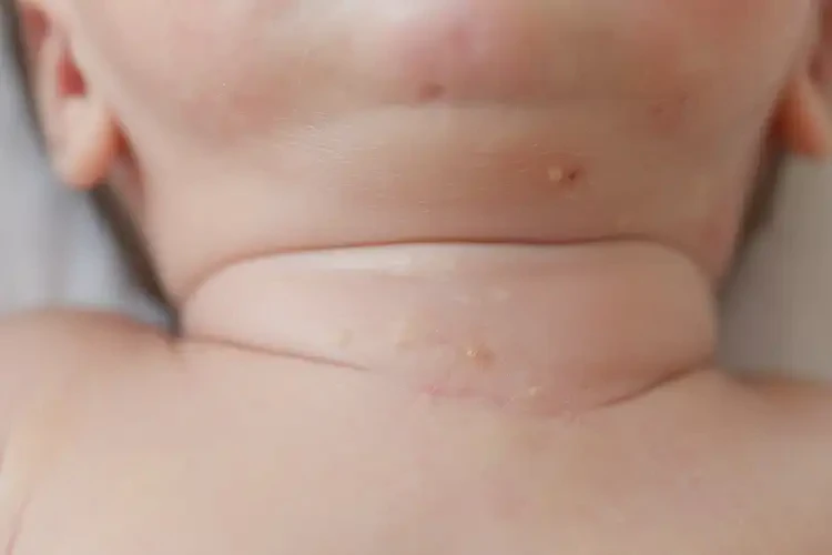 新生兒脖子出現(xiàn)濕疹可不可以徹底自愈(圖3)