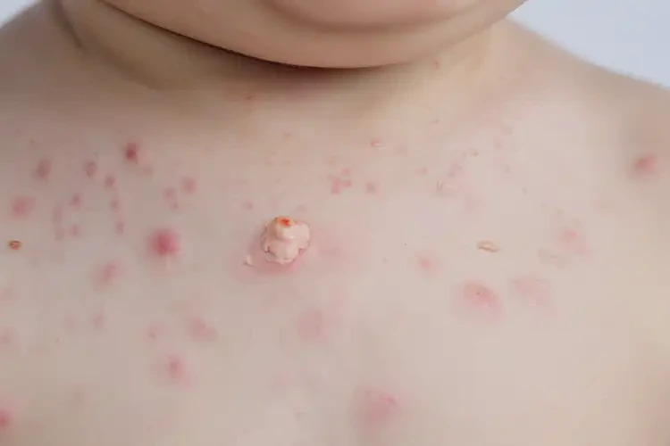 少兒脖子上經(jīng)常長濕疹可以徹底自愈嗎(圖4)
