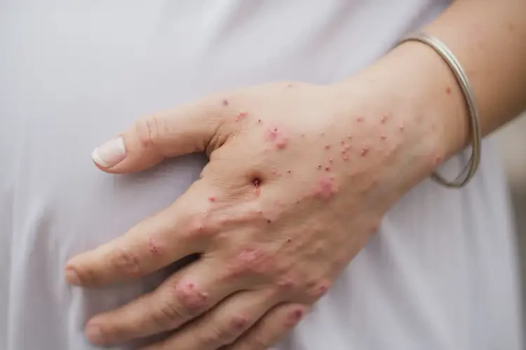 孕妇四肢出湿疹不管它会自己自愈吗(图4)