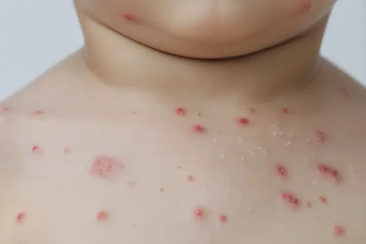 小兒脖子經(jīng)常起濕疹可不可以徹底自愈(圖4)