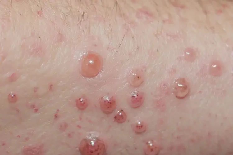 男生肚子有湿疹不管它会自己痊愈吗(图4)