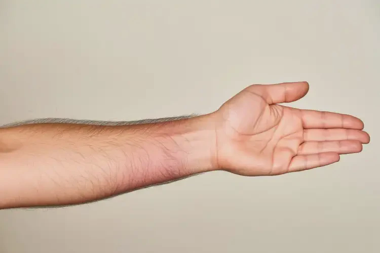 男性手臂上容易起湿疹可不可以彻底自愈(图4)