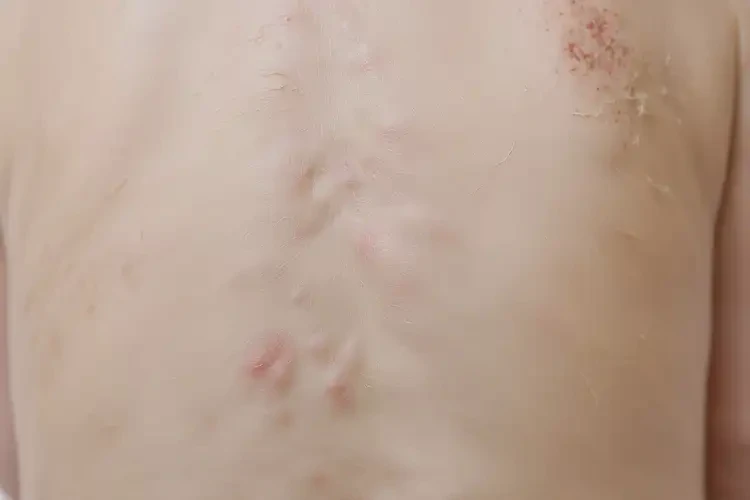 嬰幼兒全身經(jīng)常長濕疹不管它會自己好嗎(圖4)