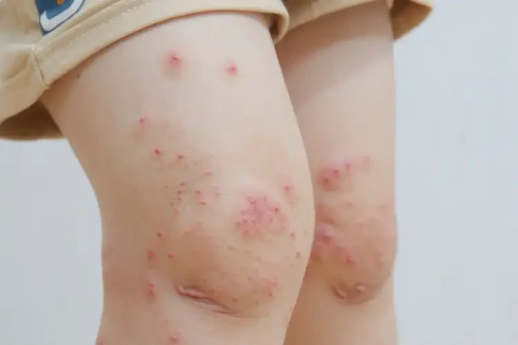 小孩四肢偶爾起濕疹可以徹底自愈嗎(圖4)