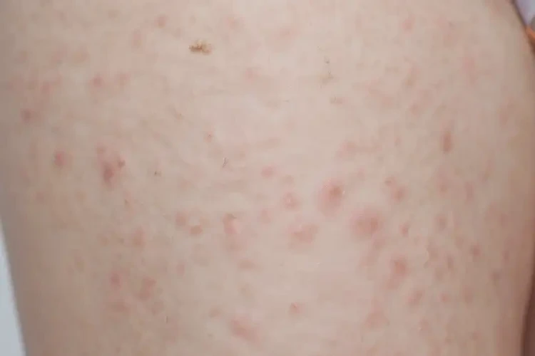 孩子大腿上出現(xiàn)濕疹能靠自己自愈嗎(圖4)