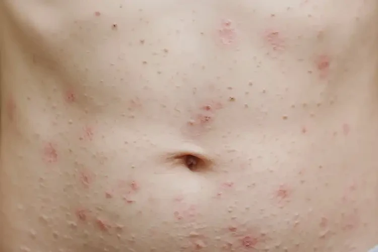 青少年肚子容易長濕疹能徹底自愈嗎(圖4)