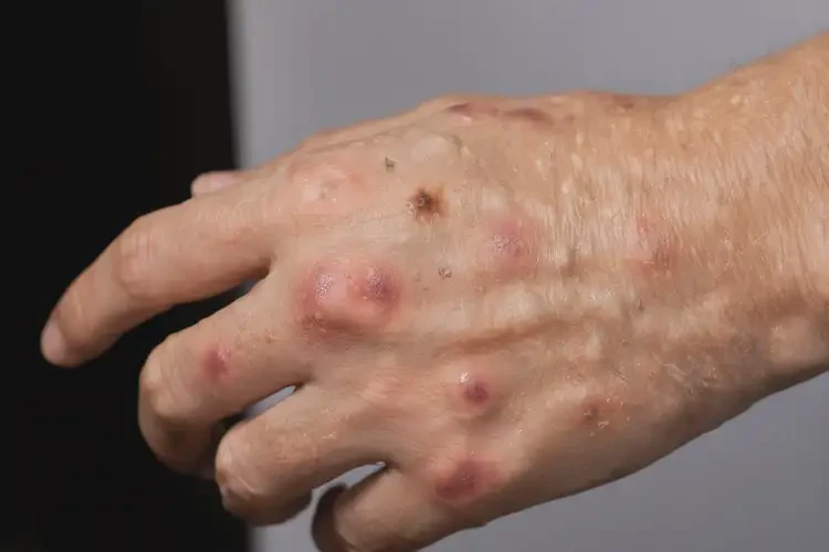 女生手上容易長濕疹能徹底自愈嗎(圖4)