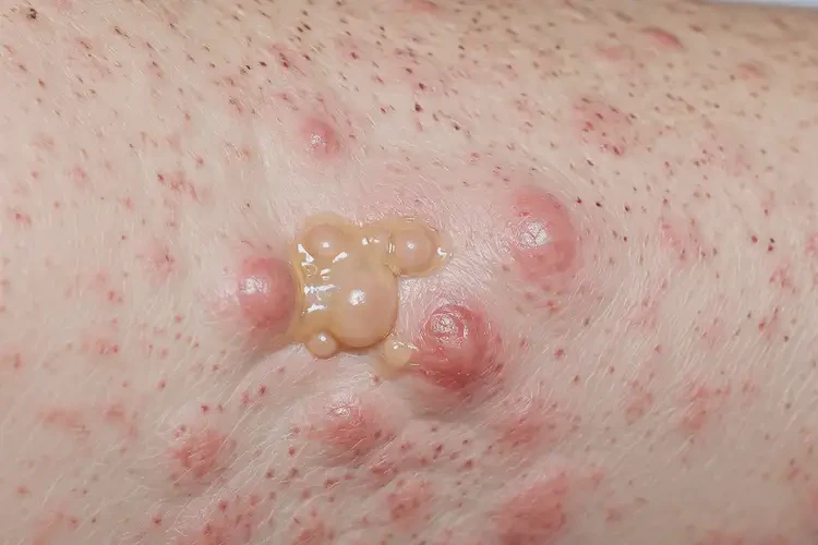 青年人屁股經(jīng)常起濕疹能不能徹底自愈(圖3)