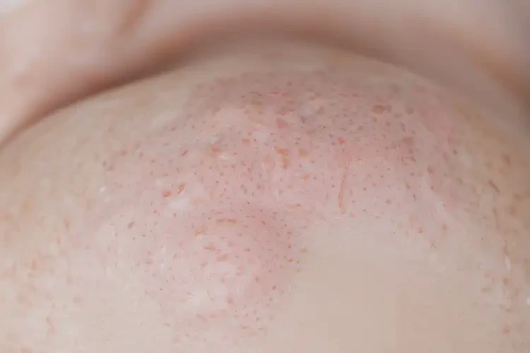 嬰幼兒脖子上偶爾起濕疹不管它會自己好嗎(圖4)