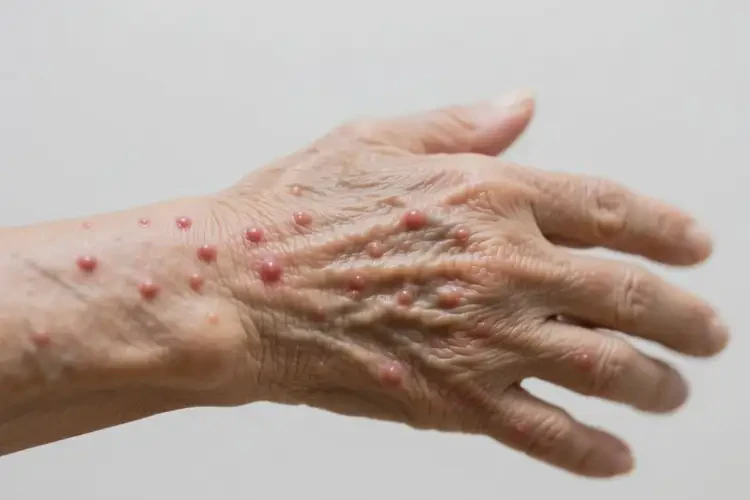 高齡老人手臂長濕疹能不能徹底自愈(圖3)