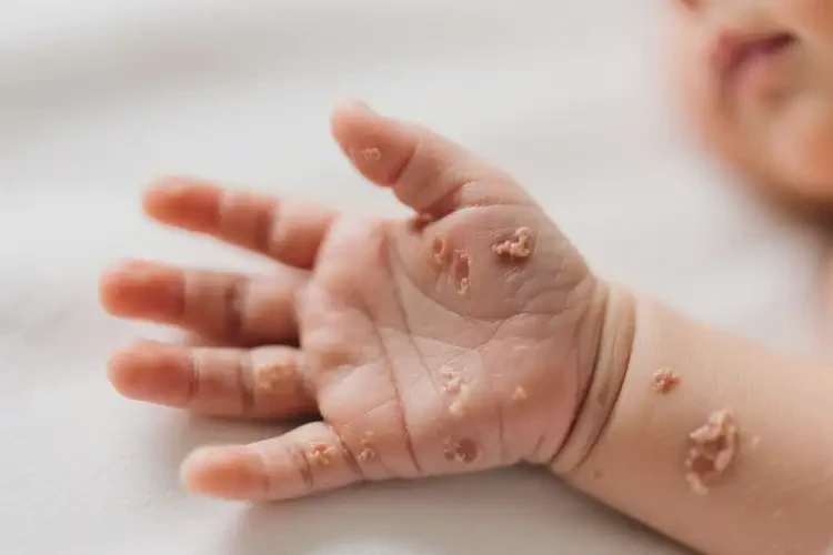 新生兒手上偶爾起濕疹能徹底自愈嗎(圖1)