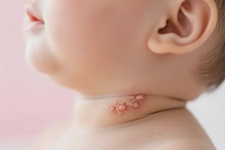 嬰兒脖子上偶爾起濕疹可以徹底自愈嗎(圖4)