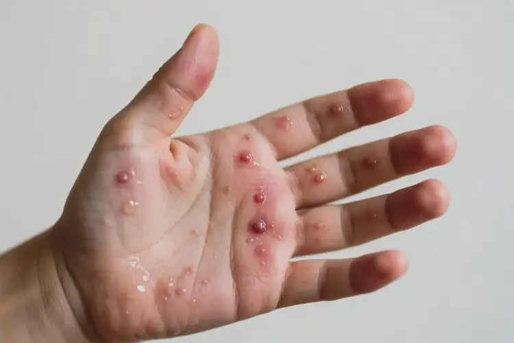 小学生手上长湿疹不管它会自己好吗(图4)