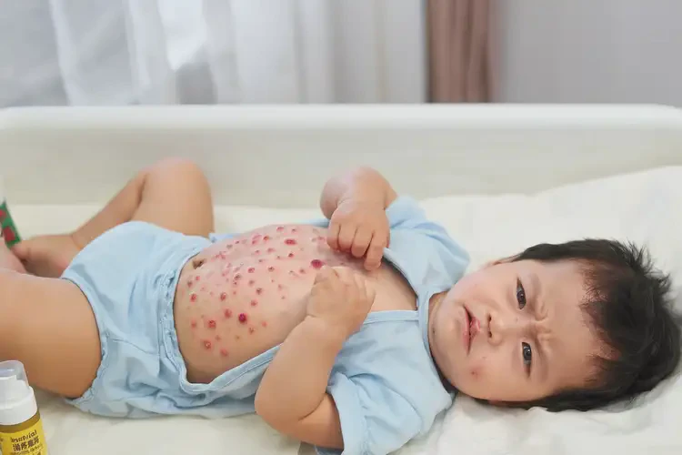 幼儿肚子起湿疹不管它会自己自愈吗(图4)