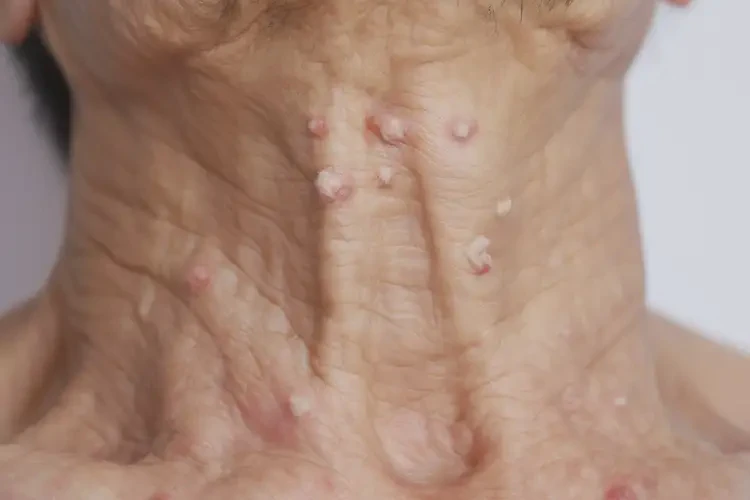 老年人脖子偶爾長濕疹不管它會自己痊愈嗎(圖4)