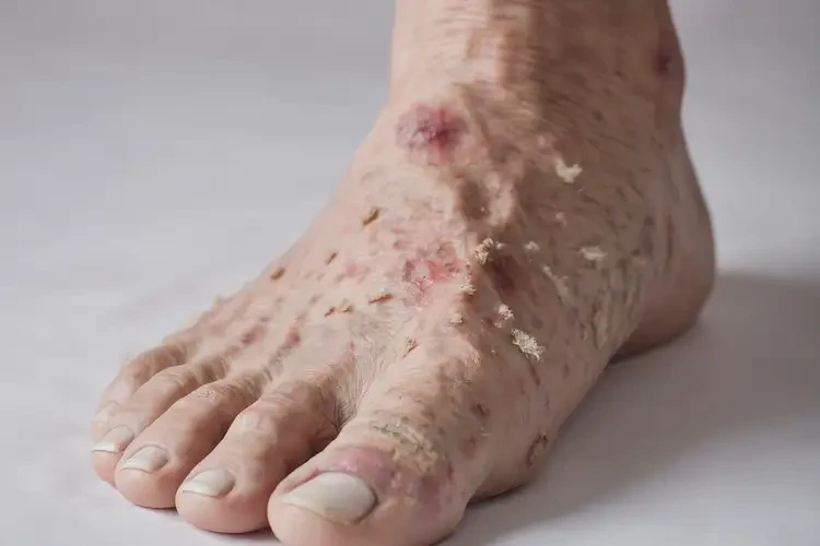 高齡老人腳上經(jīng)常長(zhǎng)濕疹可以徹底自愈嗎(圖4)