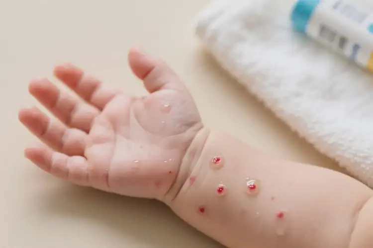 嬰兒手臂上長(zhǎng)濕疹不管它會(huì)自己痊愈嗎(圖3)