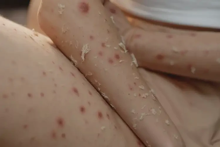 孕婦手臂上出濕疹可以徹底自愈嗎(圖4)